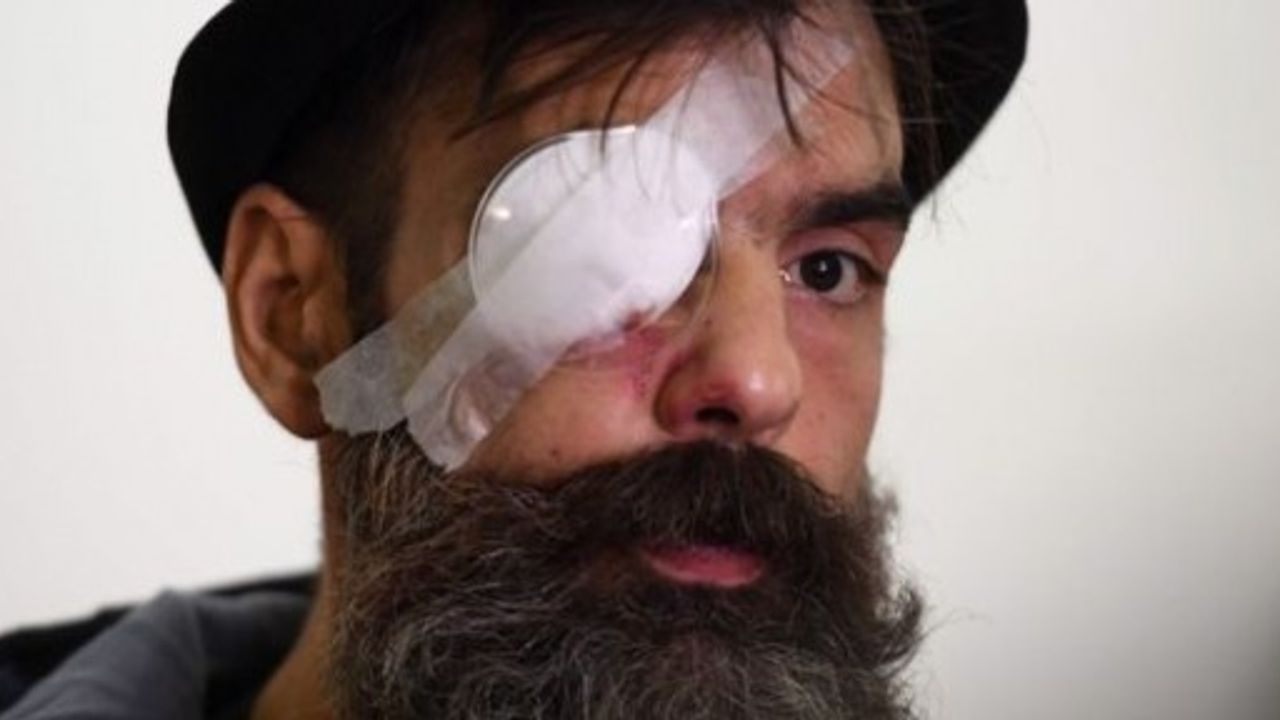 Polis şiddeti: Sarı Yelekliler’in lideri gözünü kaybetti